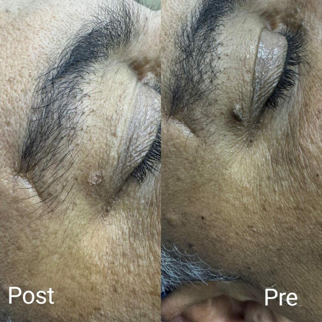 Laser removal of skin tags on the eyelid
